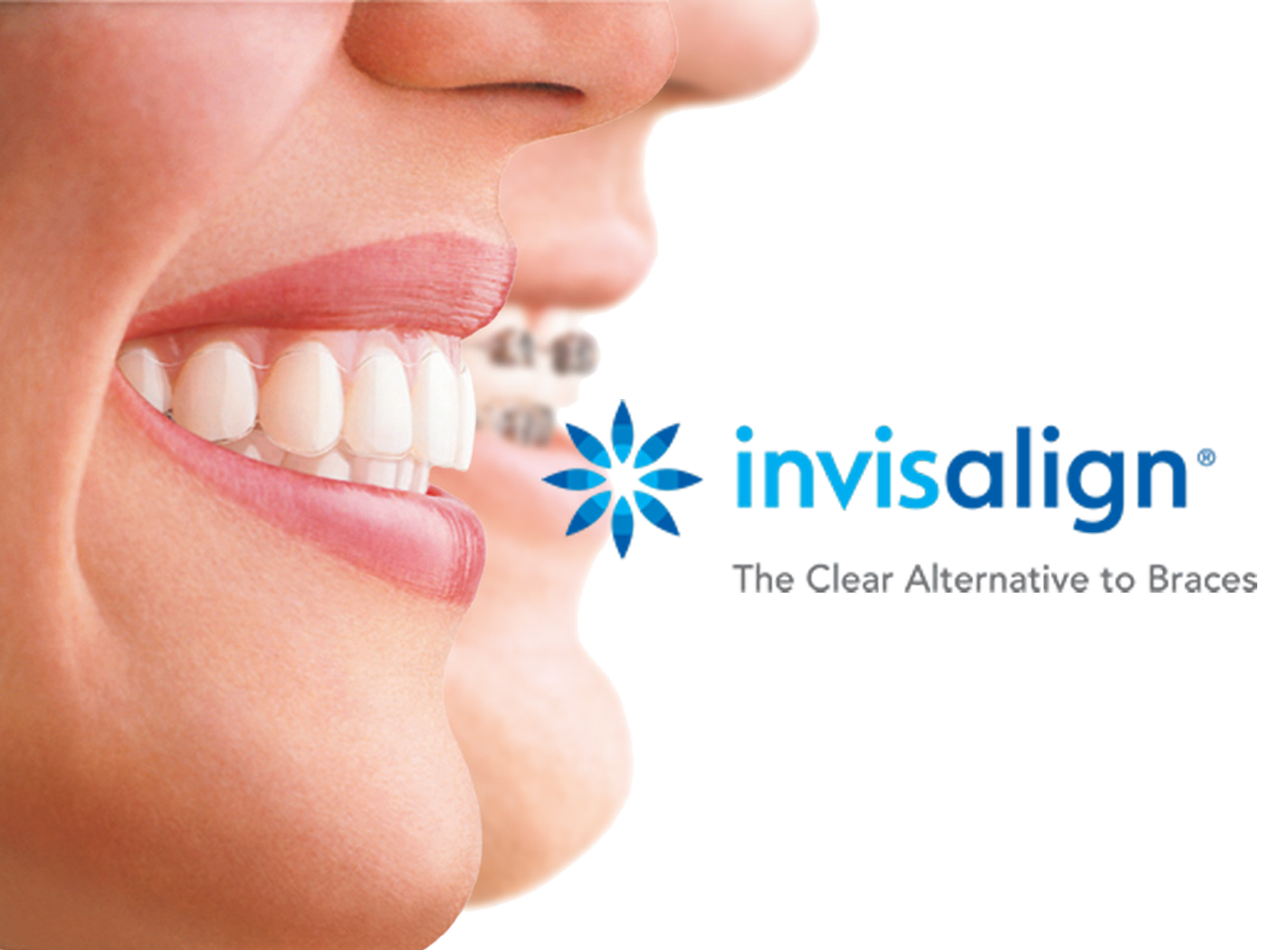 invisalign